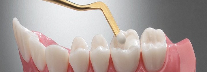 Composite filling | Dentist in Kendall